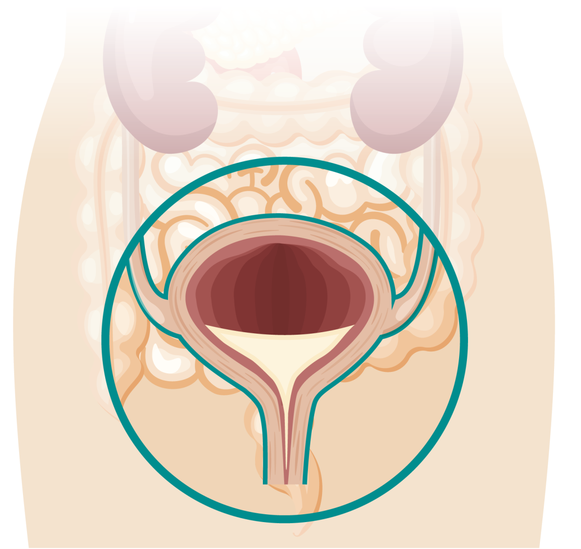 blaaskanker, oncologie, msd